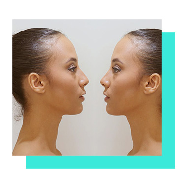rinoplastia-magic-plastic-center rinoplastia-magic-plastic-center